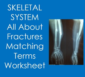 Preview of All About Fractures Matching Terms (Anatomy, Skeletal System, Health Sciences)