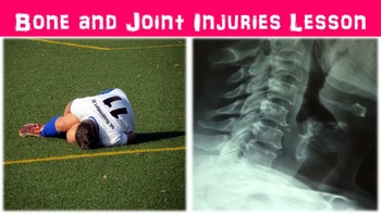 Preview of Bone and Joint Injuries No Prep Lesson w/ Power Point, Worksheet, X-Ray Activity