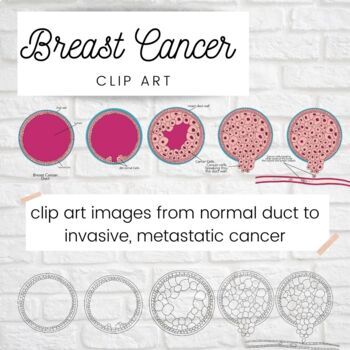 Preview of Breast Cancer Cell Changes Clip Art; Pathology