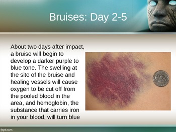 Bruise Colors and Age by Lessons by Shelle | Teachers Pay Teachers
