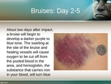 Bruise Colors and Age