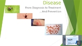 Diagnosis of Lyme disease