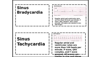 Preview of EKG rhythm flashcards
