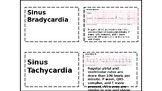 EKG rhythm flashcards