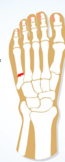 Foot Injury- Jones Fracture
