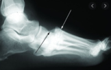 Foot Injury- Lisfranc Fracture