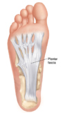 Foot Injury- Plantar Fasciitis