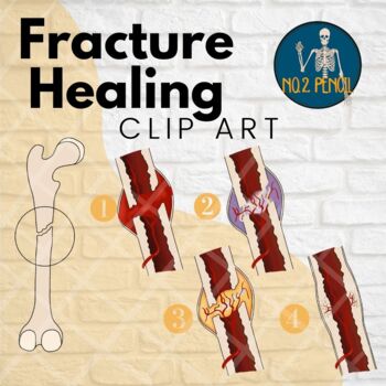 Preview of Fracture Healing, Bone healing, Bony Anatomy Clip Art