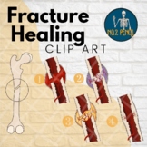 Fracture Healing, Bone healing, Bony Anatomy Clip Art