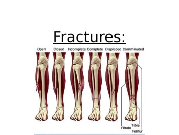 Preview of Sports medicine: Fractures PPT