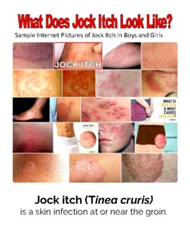 How to Know if You Have Jock Itch: 8 Steps (with Pictures)