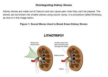 Preview of MS- PS4-2 Sound Waves Disintegrating Kidney Stones Stimulus and Questions