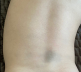 Mongolian Blue Spots - Congenital dermal melanocytosis - B