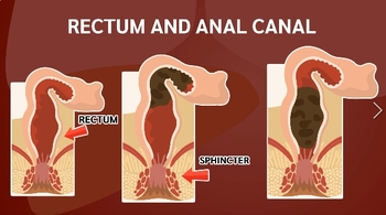 Preview of RECTUM AND ANAL CANAL