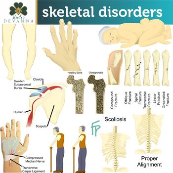 Preview of Skeletal Disorders Clip Art