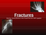 Types of Bone Fractures PowerPoint