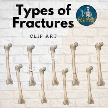 Preview of Types of Fractures Bone Anatomy Clip Art, Femur