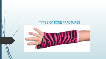 Preview of Types of Bone Fractures
